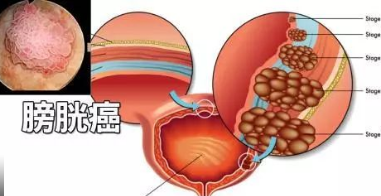 膀胱癌是指發(fā)生在膀胱黏膜上的惡性腫瘤是泌尿系統(tǒng)中最常見的腫瘤