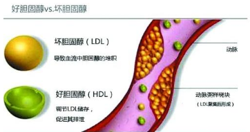 控制膽固醇水平升高是防控冠心病的關(guān)鍵舉措