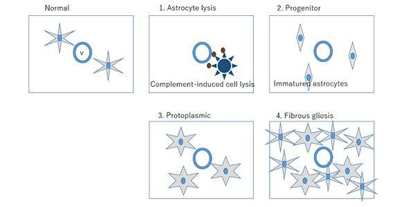 科學家為新發(fā)現(xiàn)的多發(fā)性硬化癥樣疾病制定分類方案