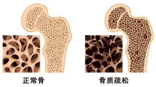 研究發(fā)現(xiàn)患有骨質(zhì)疏松癥和骨密度低的女性患聽力損失的風(fēng)險(xiǎn)增加