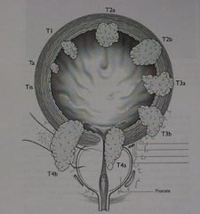 中山大學林天歆團隊揭示膀胱癌淋巴轉移提供系統(tǒng)性的解決策略