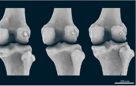 人類正在失去與骨關(guān)節(jié)炎相關(guān)的膝骨 現(xiàn)在正在卷土重來