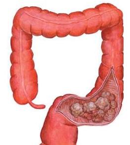 結腸癌由細菌和細胞應激推動