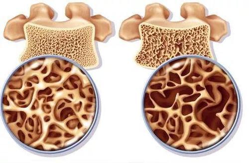 骨質(zhì)疏松癥篩查無(wú)需證明有益