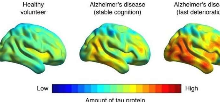 腦成像可以預(yù)測阿爾茨海默氏癥相關(guān)的記憶力減退