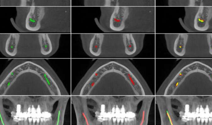 人工智能使牙醫(yī)的工作更加輕松 新模型有助于對(duì)下頜管進(jìn)行定位