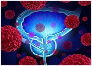 建立新的聯合療法對前列腺癌安全有效