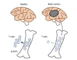 腦癌可通過在骨髓中捕獲T細胞來抵抗免疫治療