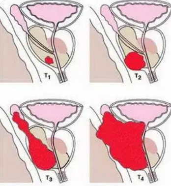 前列腺癌類器官為精準(zhǔn)治療開辟了道路