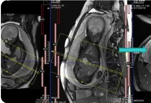 胎兒 MRI 是超聲檢測(cè)先天性心臟缺陷胎兒心外發(fā)育異常的重要輔助手段