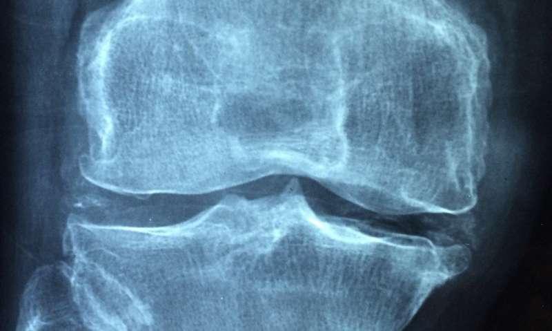 科學家開發(fā)生物物理模型以幫助更好地診斷和治療骨關節(jié)炎