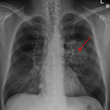 表觀遺傳調(diào)節(jié)劑解釋了為什么一些肺癌患者對(duì)常見療法產(chǎn)生抗藥性