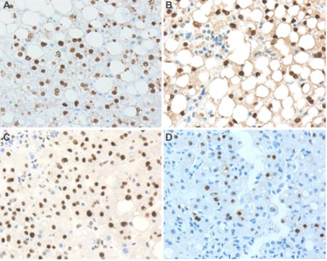p-STAT3 和 c-Myc 的表達與非酒精性脂肪性肝病中 P2-HNF4α 的表達相關