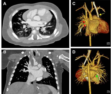 光子計(jì)數(shù) CT 為患有心臟缺陷的嬰兒提供卓越的成像