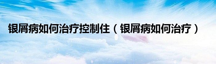 銀屑病如何治療控制?。ㄣy屑病如何治療）