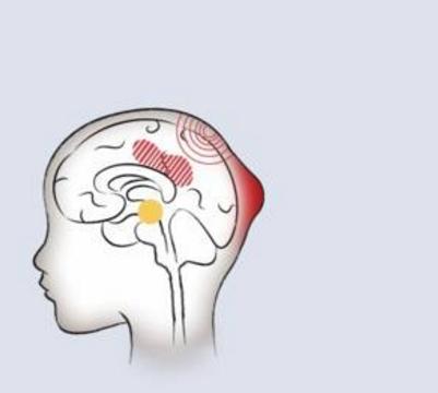 科學家教機器預測與運動相關的腦震蕩的恢復時間