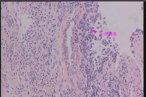 Pembrolizumab可有效作為晚期非小細(xì)胞肺癌的一線治療藥物