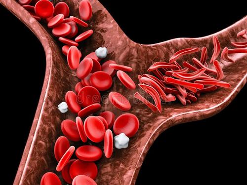 鐮狀細(xì)胞基因療法通過測(cè)試