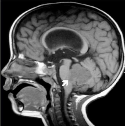 研究人員呼吁對兒童腦癌進(jìn)行常規(guī)基因篩查