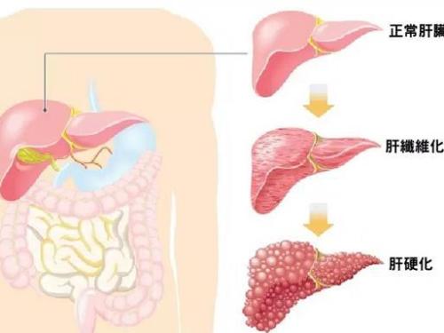 Obeticholic acid改善肝纖維化和NASH的其他組織學特征